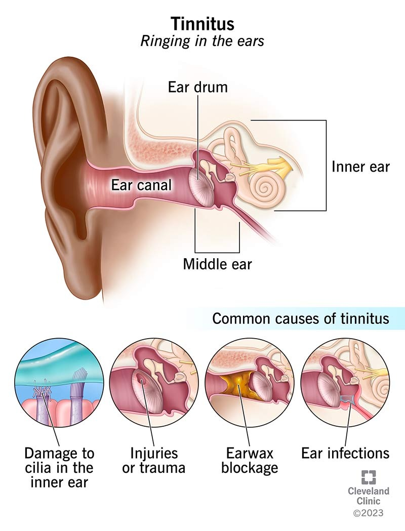 Medical illustration of the ear showing common causes of tinnitus: damage to cilia in the inner ear, injuries, earwax blockage and ear infections